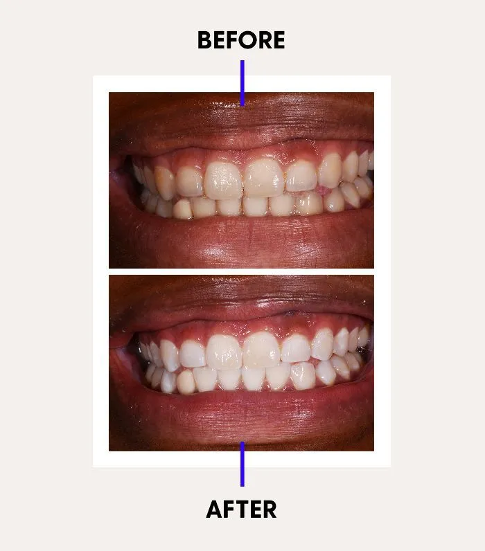 30224 teeth whitening stratford diet restriction