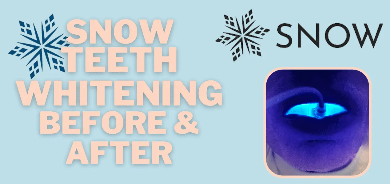 30225 snow teeth whitening vs professional