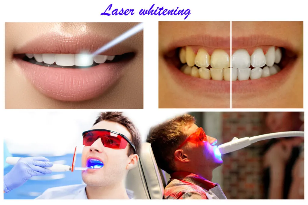 30226 minimally invasive teeth whitening