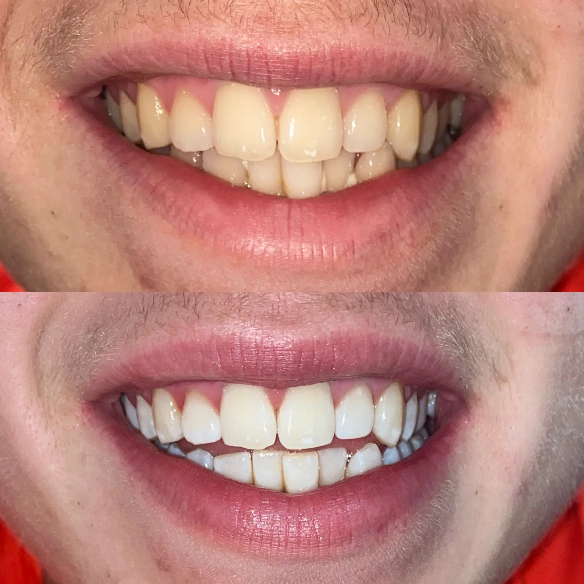 30226 teeth whitening aftercare