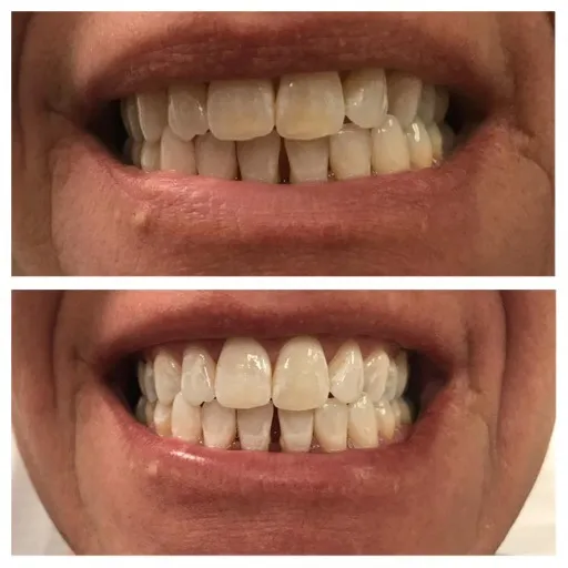 30226 teeth whitening cost