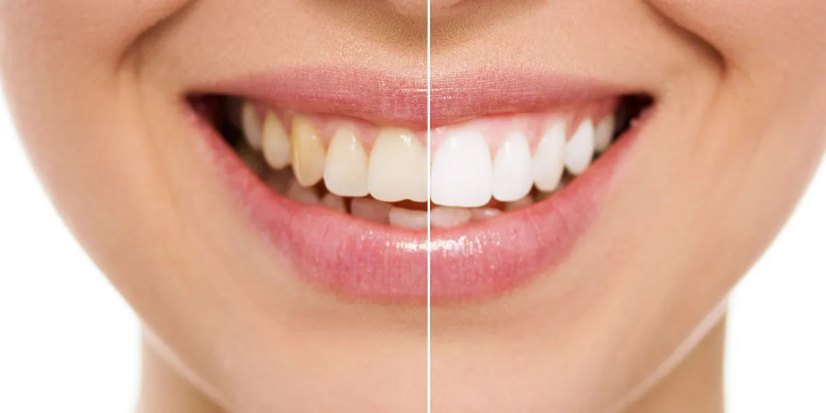 30227 teeth whitening ga 1