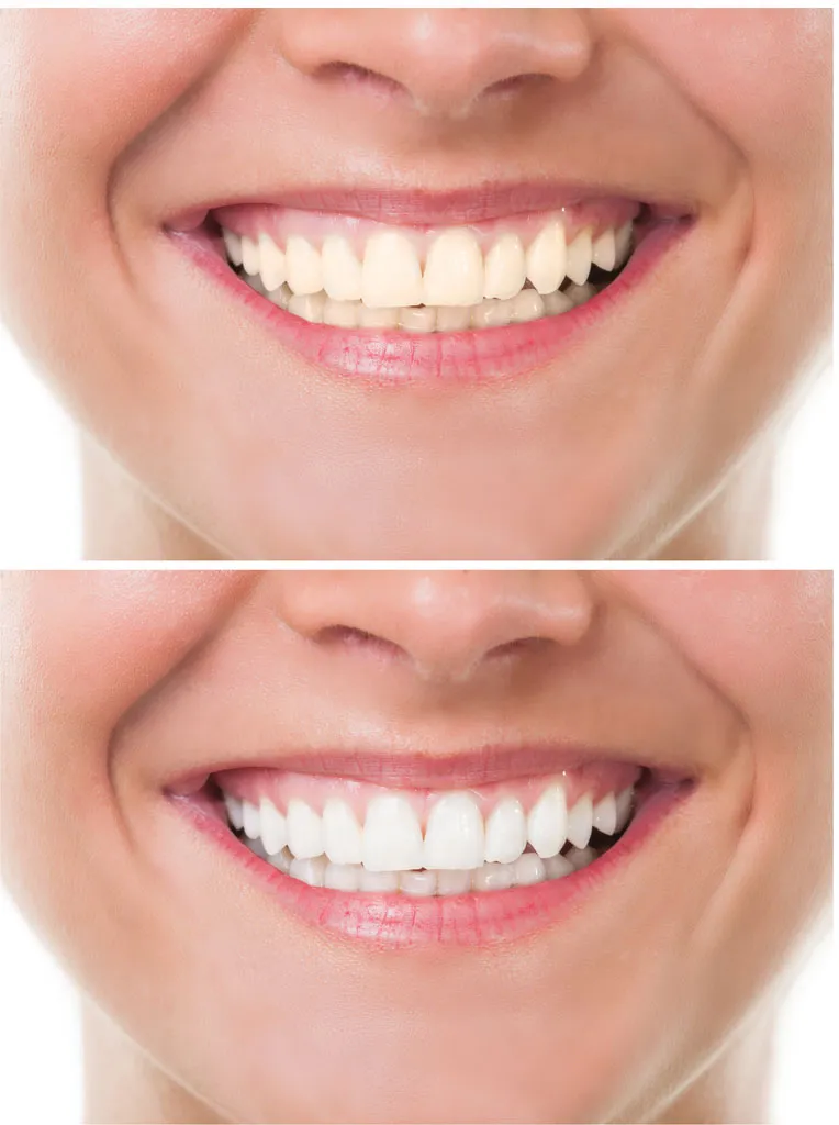 30227 teeth whitening process