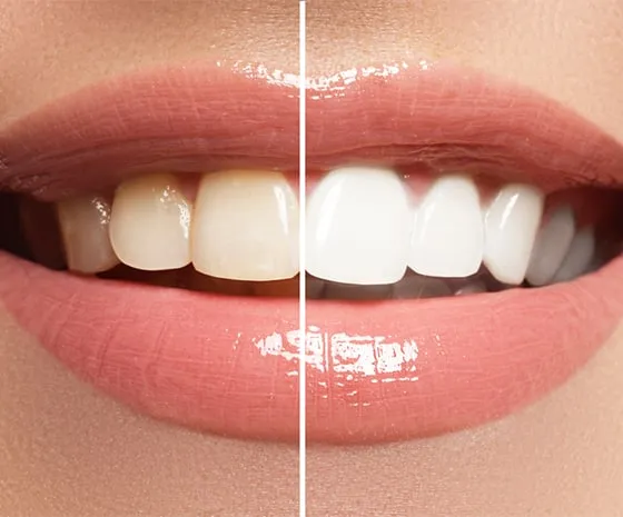 30227 teeth whitening results
