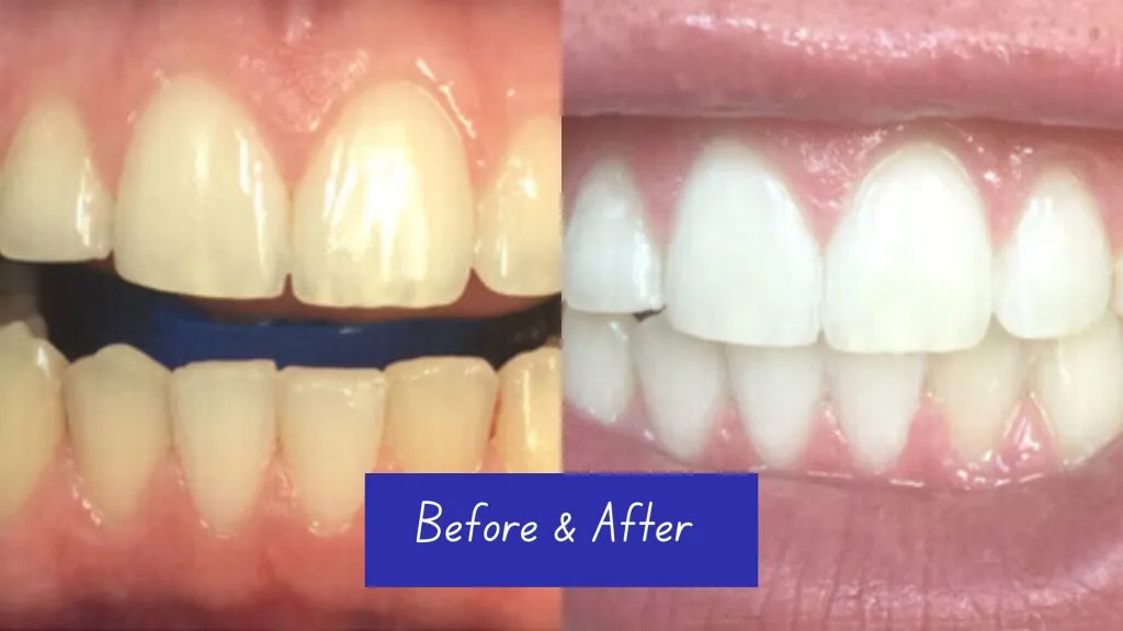 30227 teeth whitening smile