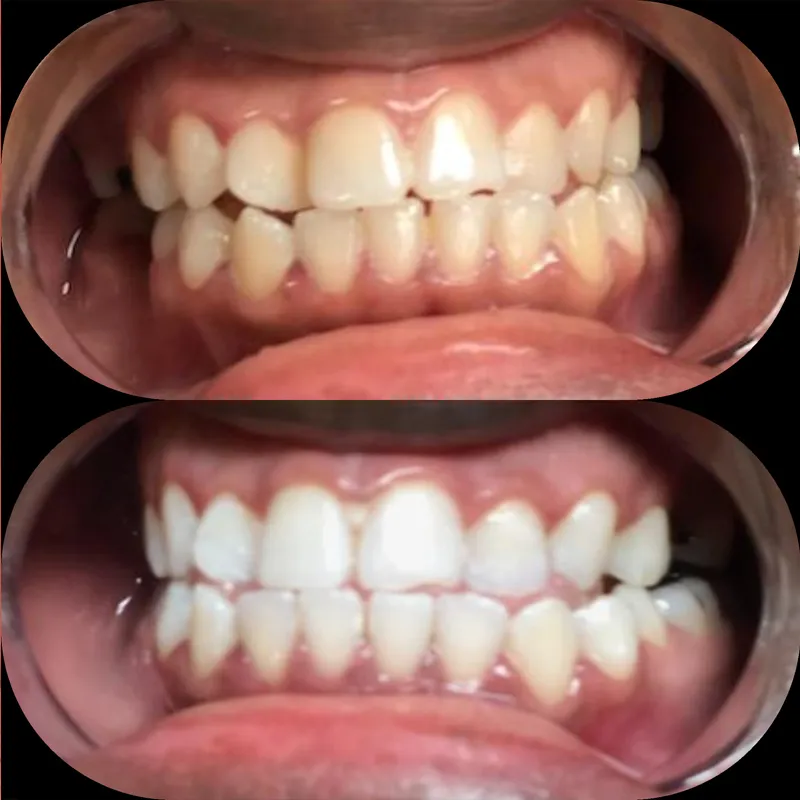 30234 teeth whitening new orleans 3