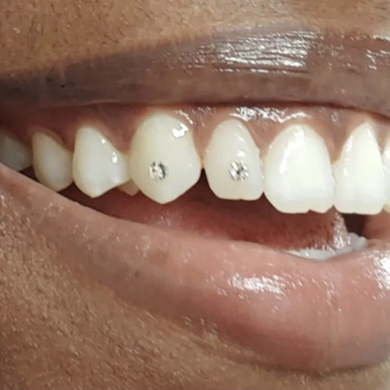 30234 teeth whitening new orleans 4