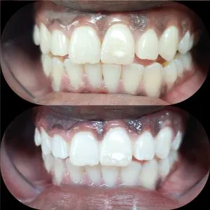 30234 teeth whitening new orleans 5