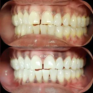 30234 teeth whitening new orleans 7