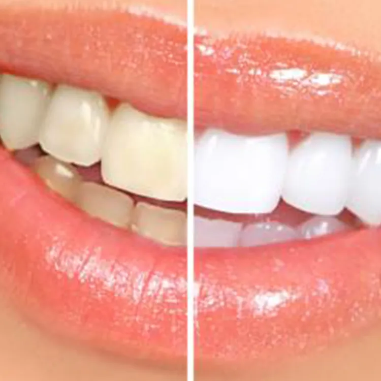 30239 teeth whitening york 2