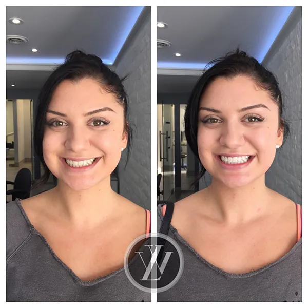 30239 teeth whitening york 3