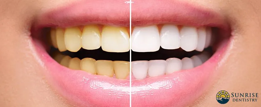 30240 teeth whitening diet