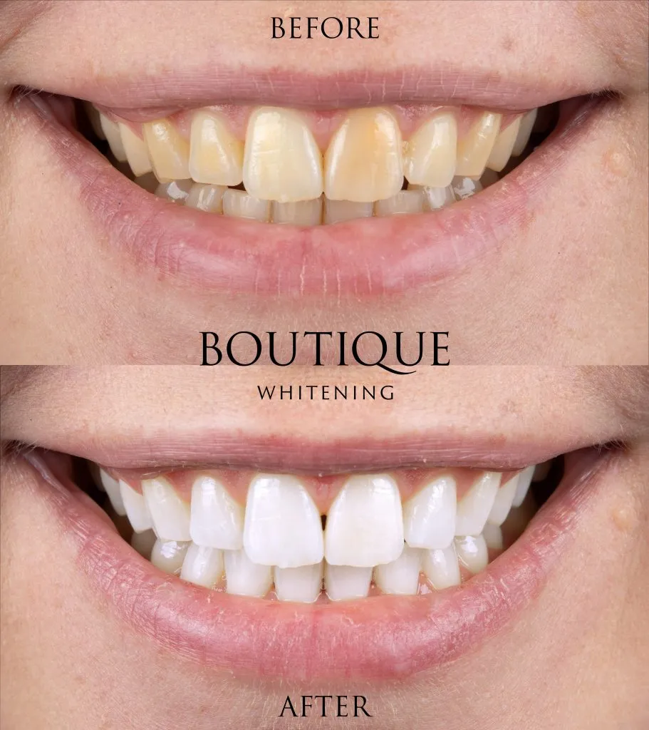 30247 teeth whitening south surrey before after