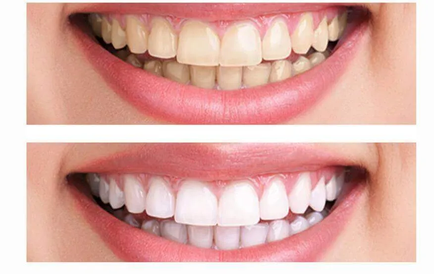 30247 teeth whitening south surrey confidence