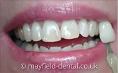 /img/30247-teeth-whitening-south-surrey-staining-foods.webp