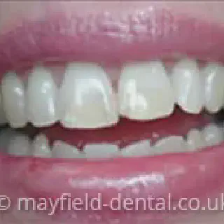 /img/30247-teeth-whitening-south-surrey-staining-foods.webp