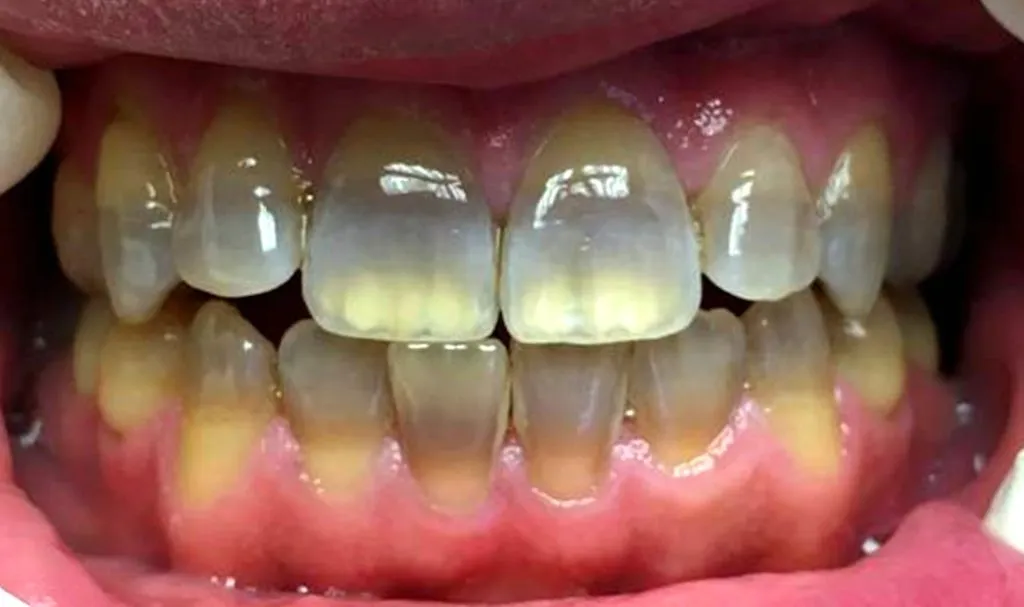 30251 dental veneers