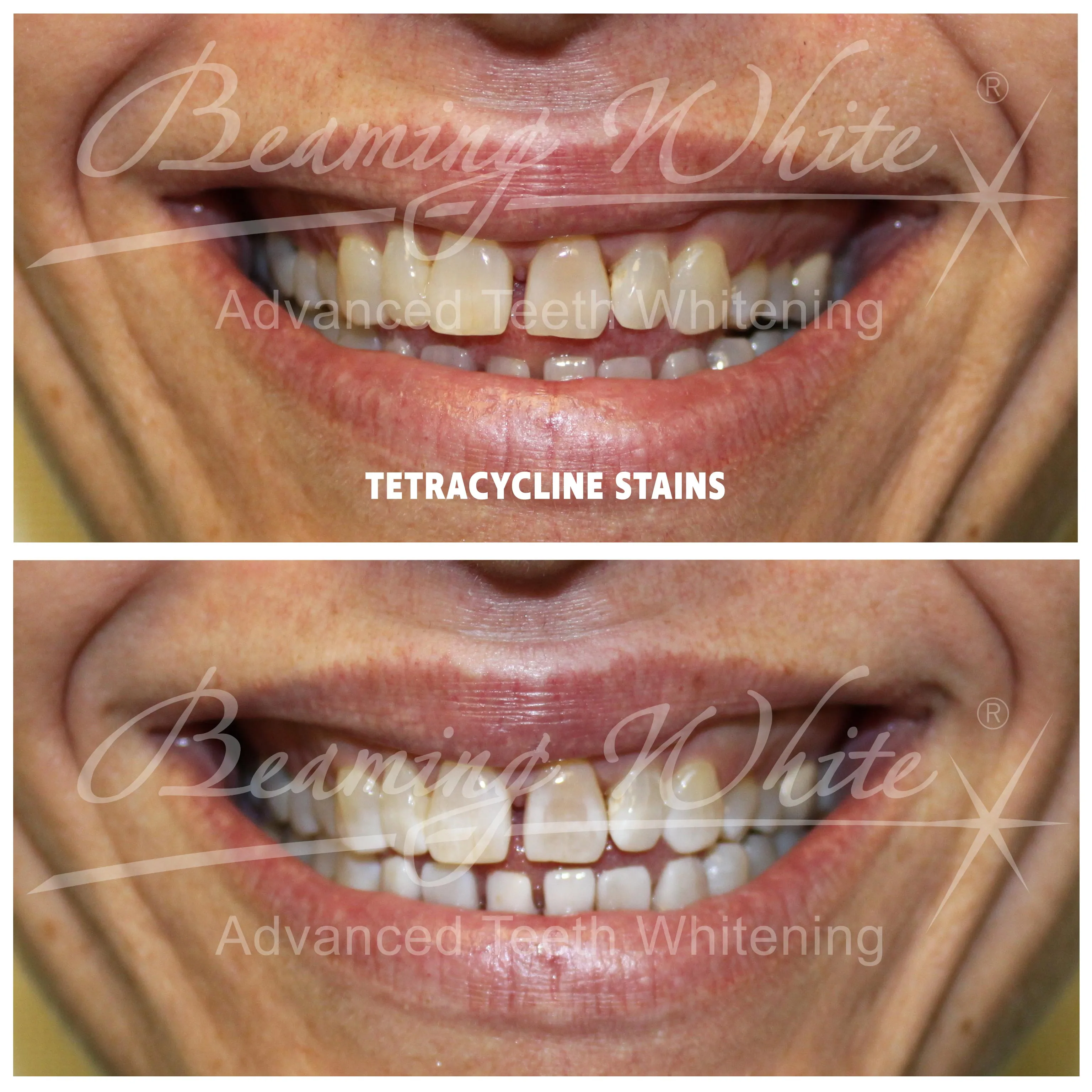 30251 laser teeth whitening