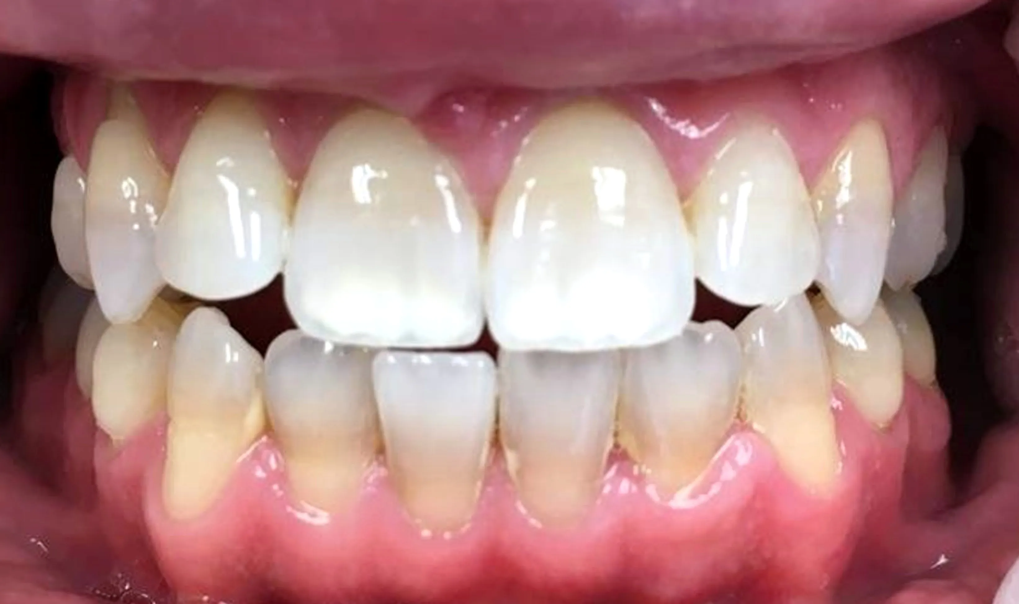 30251 professional teeth whitening