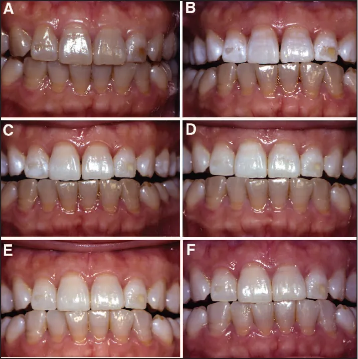 30251 tetracycline staining causes