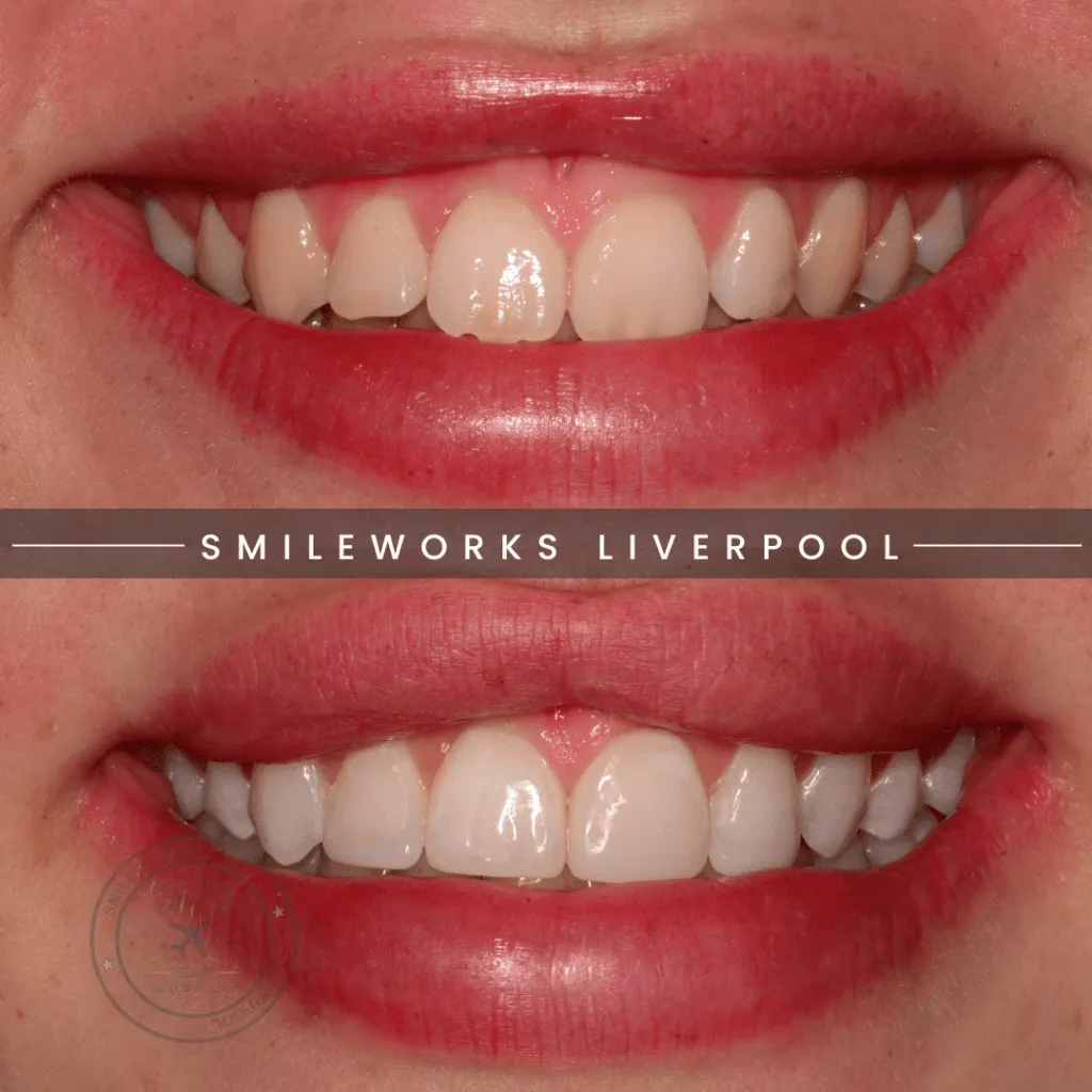 30254 teeth whitening before after