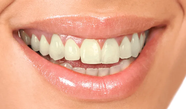 /img/30254-teeth-whitening-maintenance.webp
