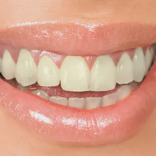 /img/30254-teeth-whitening-maintenance.webp