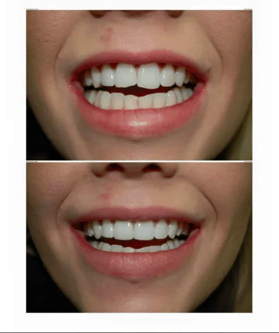 30254 teeth whitening procedure