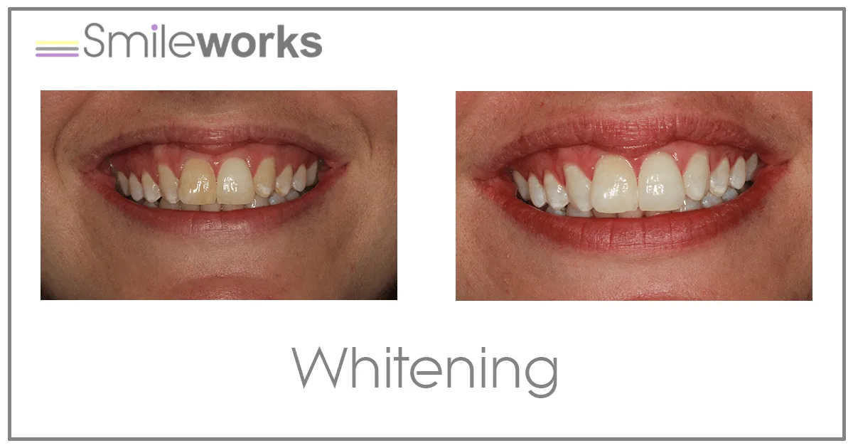 30254 teeth whitening products