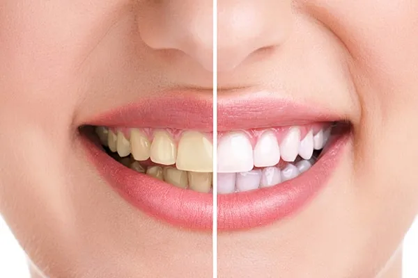 30263 teeth discoloration causes