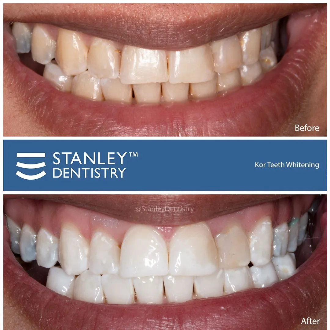 30263 teeth whitening durham nc overview