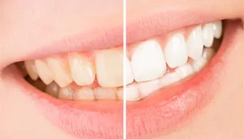 30263 whitening toothpastes