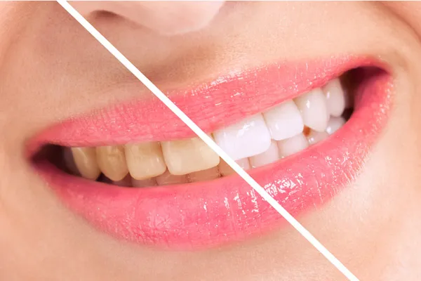 30267 professional teeth whitening