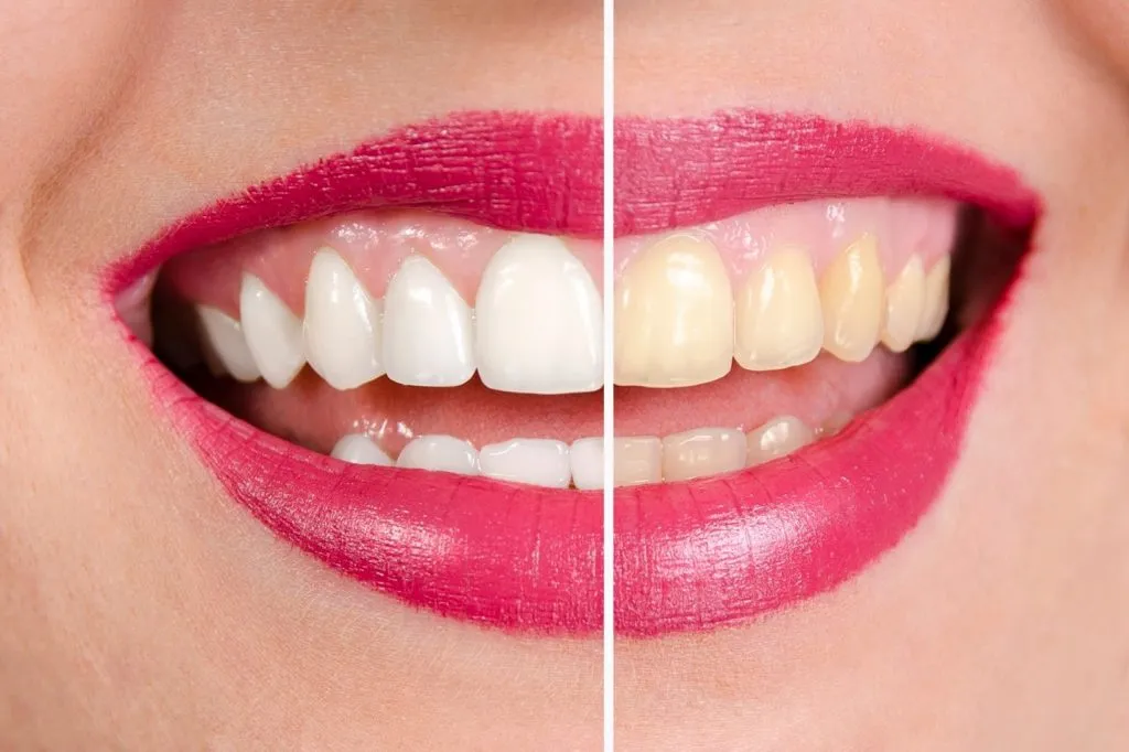 30267 teeth whitening options