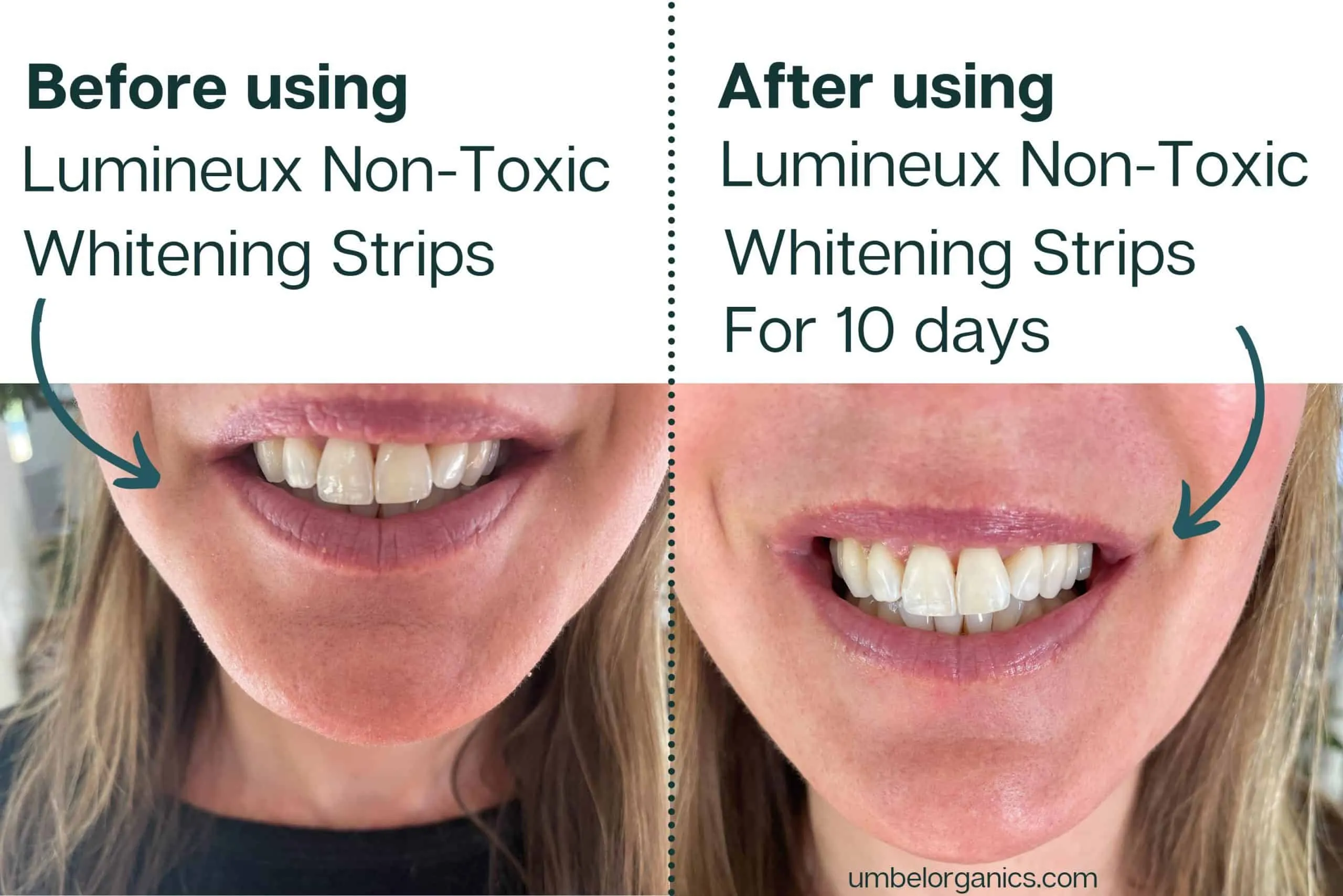 30269 crest whitening strips before after