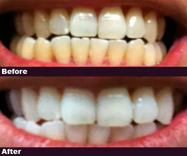30269 post whitening care