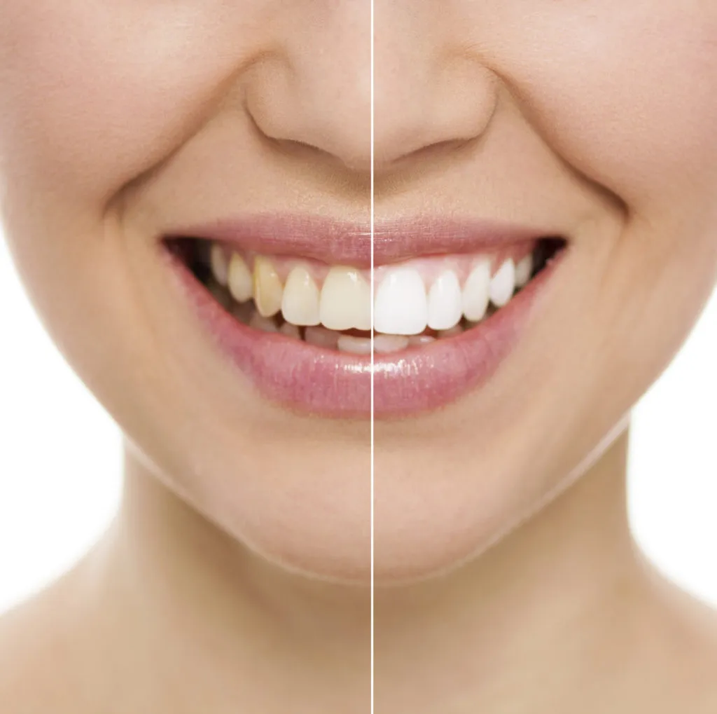30272 foods to avoid teeth whitening
