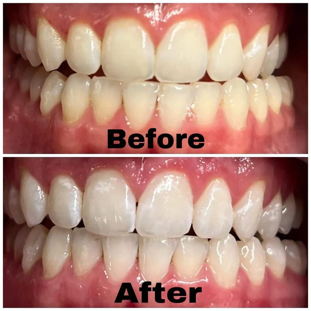 30273 in office teeth whitening
