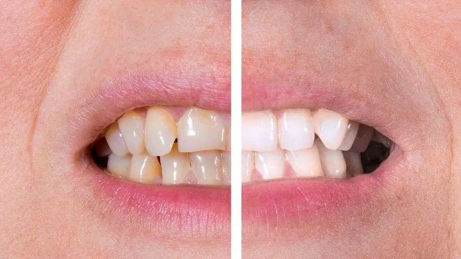 30279 professional teeth cleaning