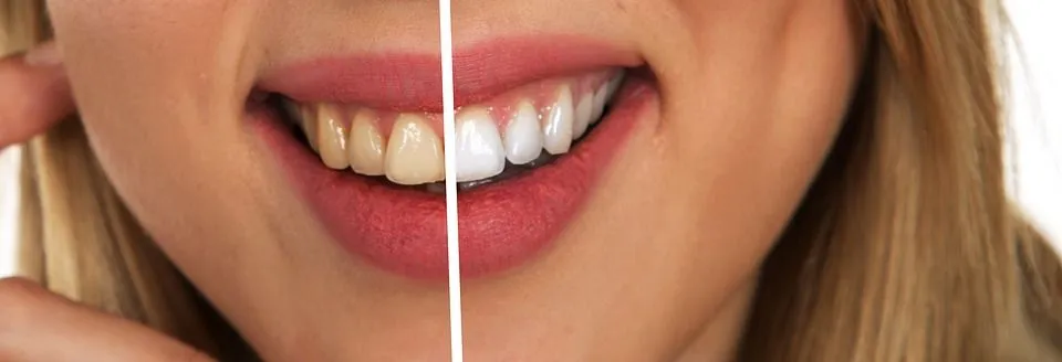 /img/30279-teeth-whitening-results.webp