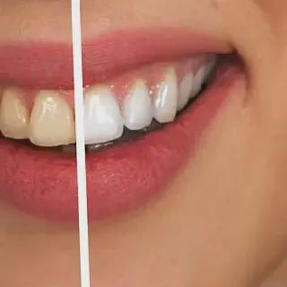 /img/30279-teeth-whitening-results.webp