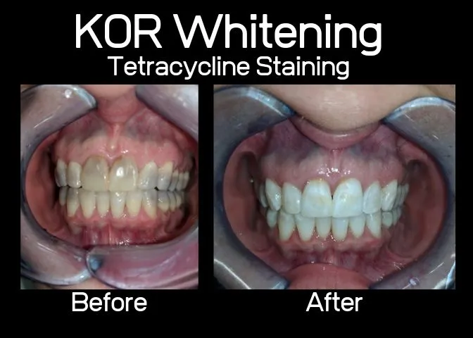 30281 find kor whitening dentist