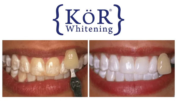 30281 kor whitening results