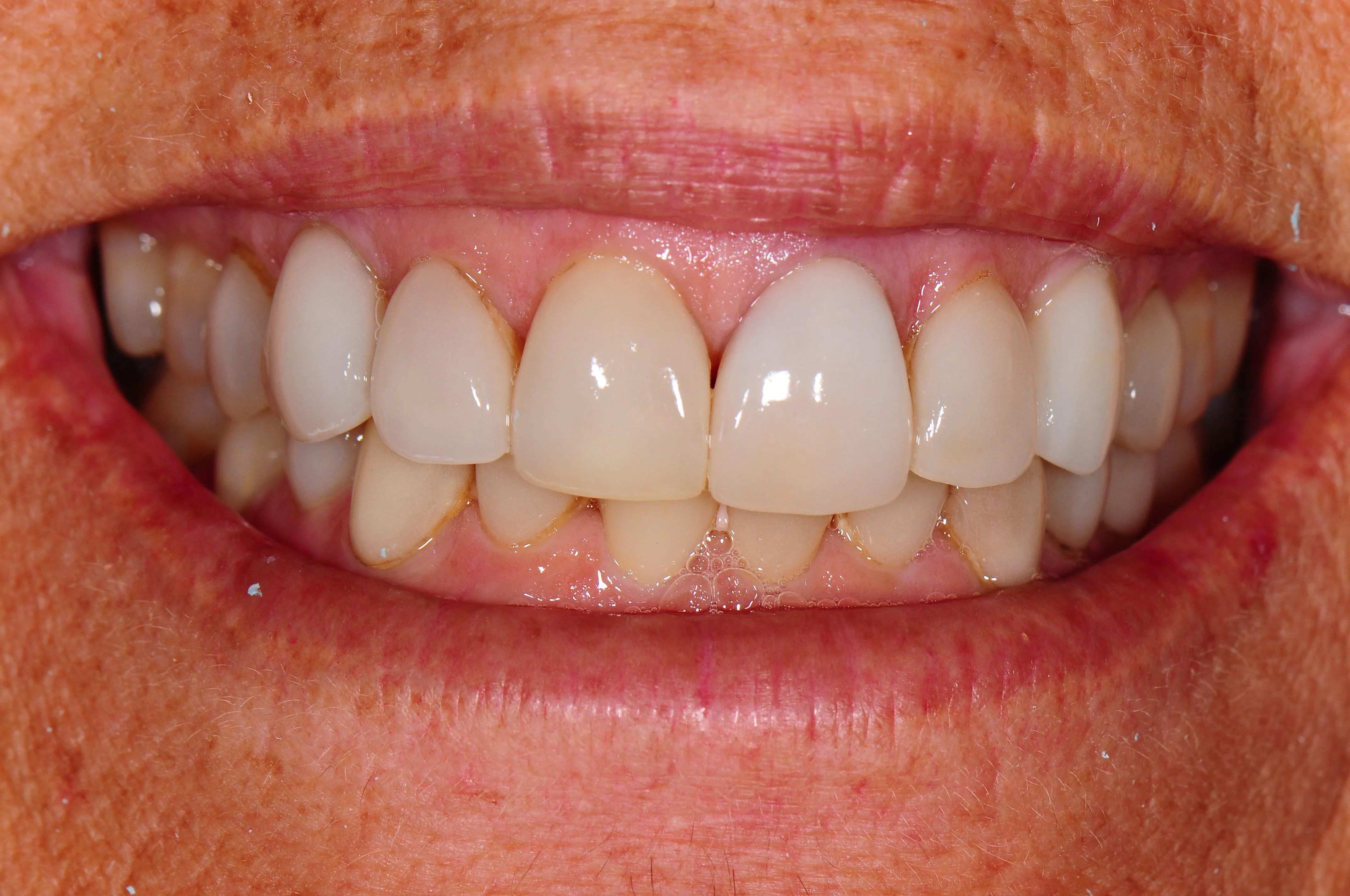 30282 professional teeth whitening