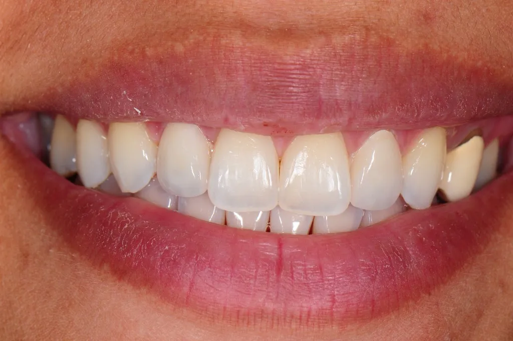 30282 teeth whitening before after