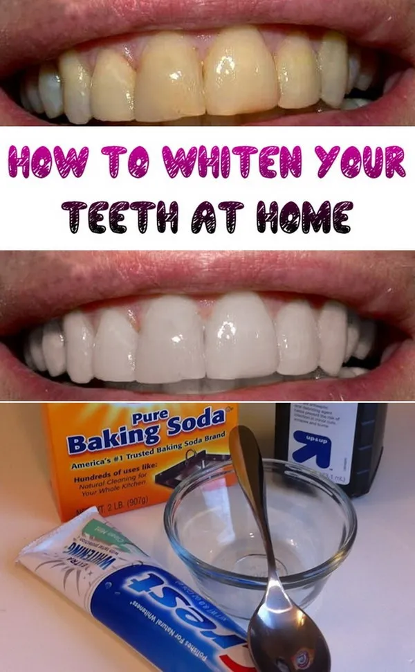 30286 teeth whitening at home intro