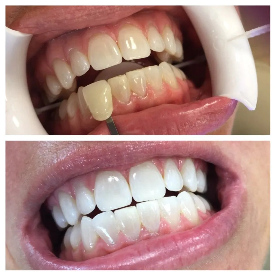 30287 teeth whitening maintenance