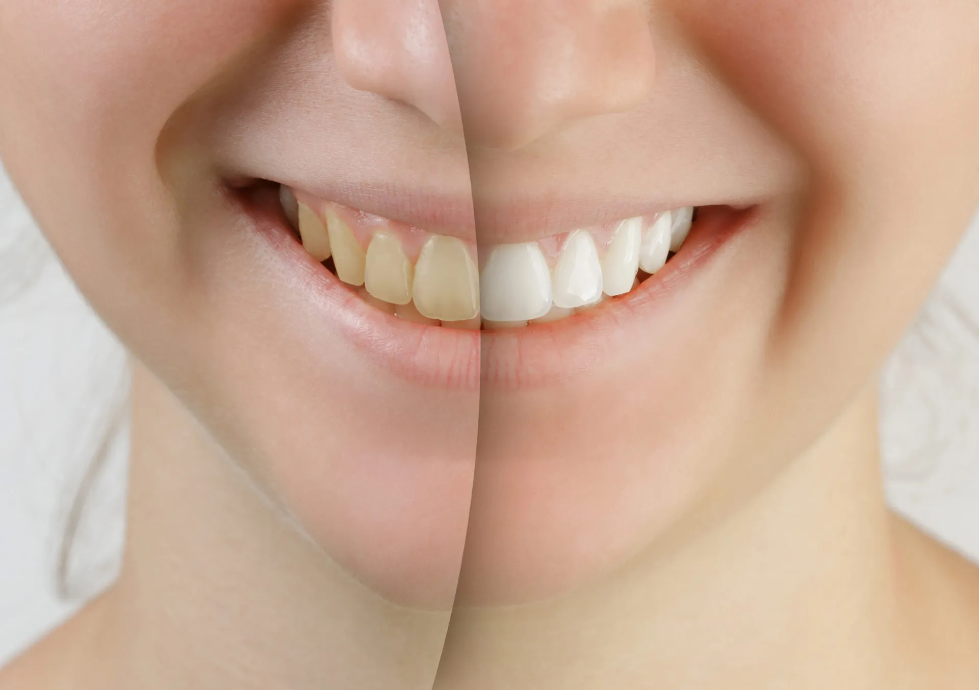30287 teeth whitening procedure