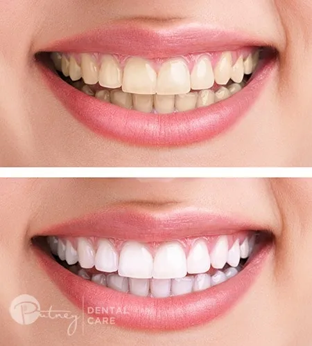 30287 teeth whitening smile