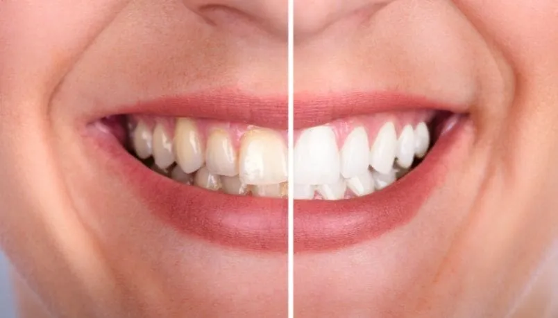 30288 teeth whitening vero beach before after